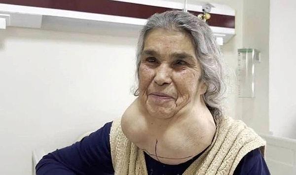 Boynun ön alt kısmında büyük bir şişliğin oluşmasına rağmen doktorlardan korktuğu için 50 yıldır hastaneye gitmeyen 67 yaşındaki Zeliha Çaylan'ın boynunda oluşan 2 kiloluk guatrı ameliyatla alındı.