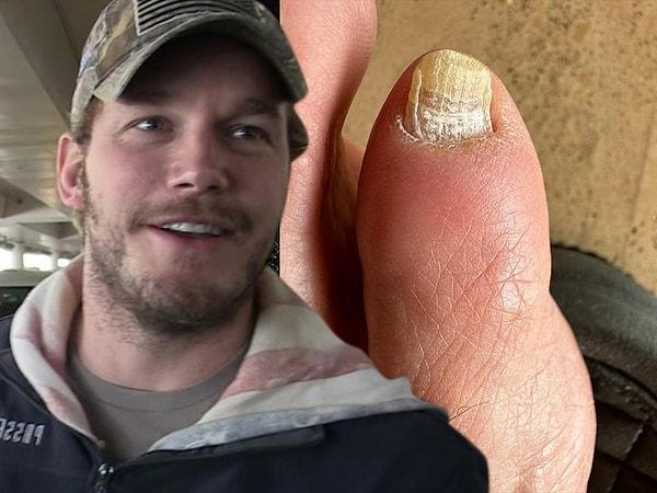 3. Chris Pratt, enfekte olan ayak baş parmağını Instagram hesabında paylaşmıştı.