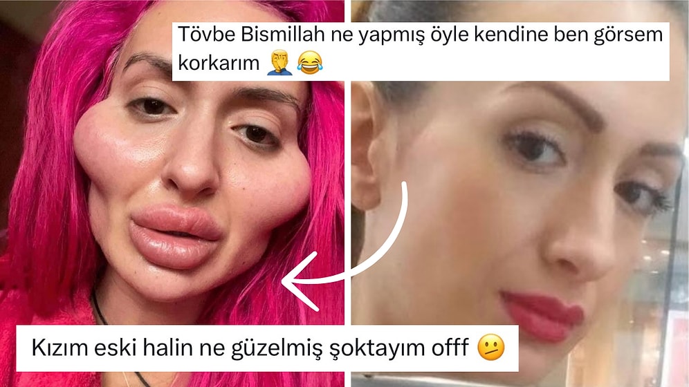 Dünyanın En Büyük Elmacık Kemiğini Yaptıran ‘Testere’ Anastasia Pokreshchuk’un Eski Hali Dillere Fena Düştü!