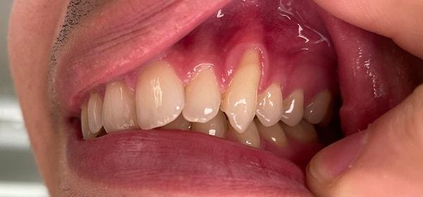 19. Azı dişleri çoğu insanın ağzındaki en koyu renkli dişlerdir.