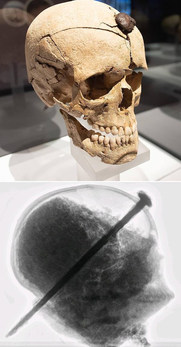 10. M.Ö 3. yüzyılın sonlarında ölen, 16 ila 18 yaşları arasındaki genç bir adama ait demir çiviyle delinmiş kafatası.