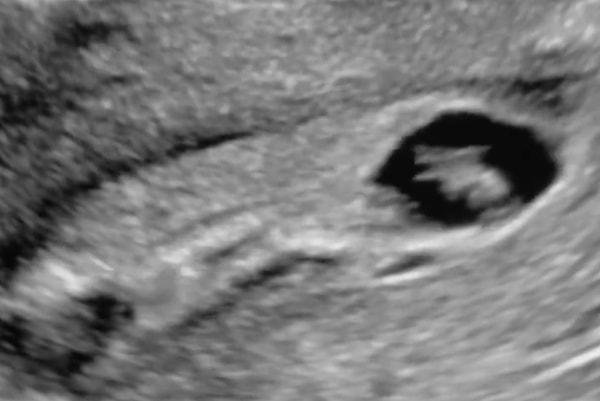 Bir doktor, ultrason muayenesi sırasında canlı olan bir bebeğin tam o anda ana rahminden kopup, düştüğünü anları paylaştı.