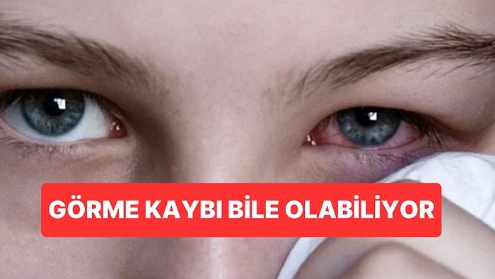 Kırmızı Göz Hastalığına Dikkat: Görme Kaybına Bile Yol Açabiliyor