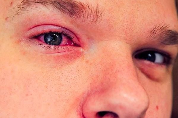 “Konjonktivit göz küresi ve göz kapakları iç yüzeyini örten konjonktiva adı verilen zar tabakasının iltihaplı enfeksiyonudur. En sık kırmızı göz nedeni olan konjonktivitlerin birden çok nedeni bulunmaktadır.”