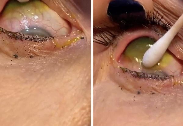 Bir kadın, yerinden oynayan lenslerinin düştüğünü varsayarak kontrol etmeyince gözlerinde onlarca lens birikti.