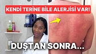 Suya Alerjisi Olduğu İçin Zar Zor Duş Alan Kadının Yaşadıkları Halinize Şükrettirecek