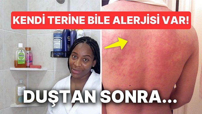 Suya Alerjisi Olduğu İçin Zar Zor Duş Alan Kadının Yaşadıkları Halinize Şükrettirecek