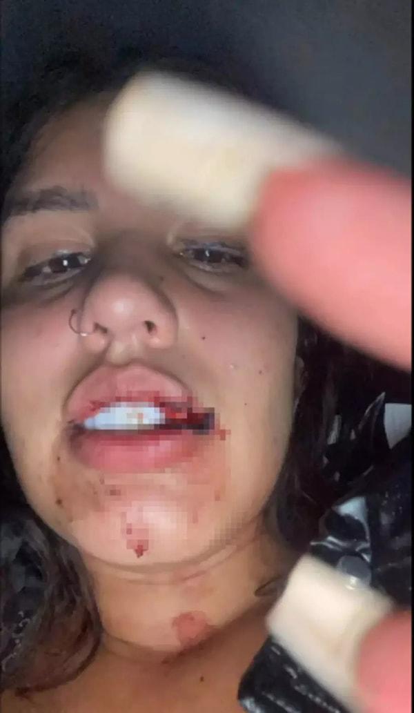 Brezilyalı sosyal medya fenomeni saldırının ardından yaşadığı şiddetin izlerini göstermek için Instagram'da paylaşım yaptı. Fenomen ismin paylaşımlarında kan lekeli mavi bir gömlek vardı, kanlı ve şişmiş dudağı ve çenesinden ve boynundan aşağı akan kurumuş kan vardı.