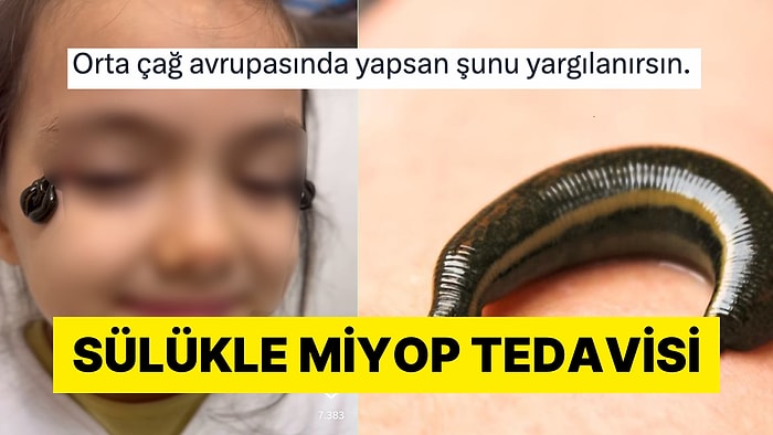 Sülük Kullanarak Göz Numarasını Küçülttüğünü İddia Eden Hacamatçı Tartışma Yarattı