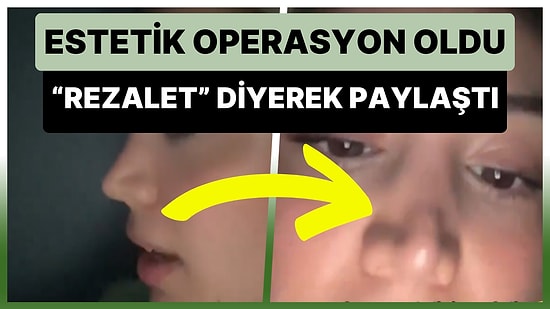 Estetik Ameliyattan Sonra Burnunun Görüntüsünü, 'Rezalet' Diyerek Paylaşan Kadın