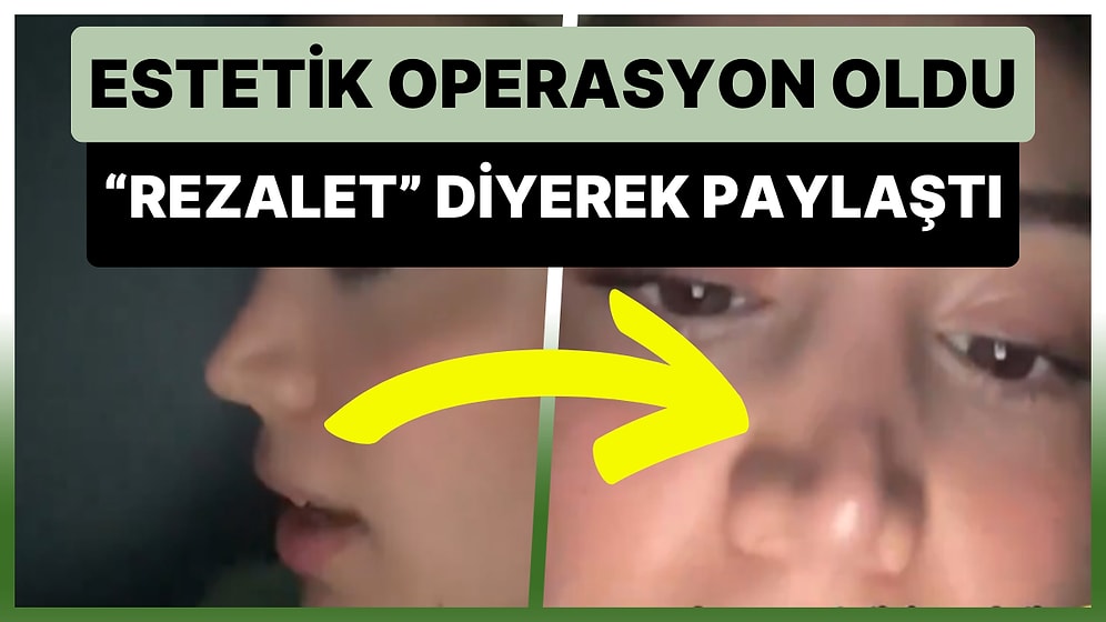 Estetik Ameliyattan Sonra Burnunun Görüntüsünü, 'Rezalet' Diyerek Paylaşan Kadın