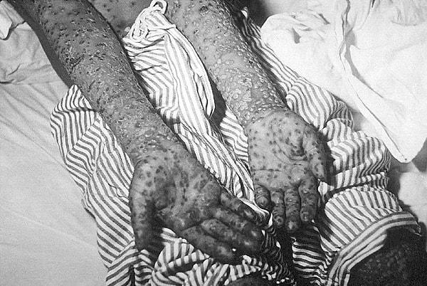 11. Çiçek Hastalığı olmuş kadının kolları.