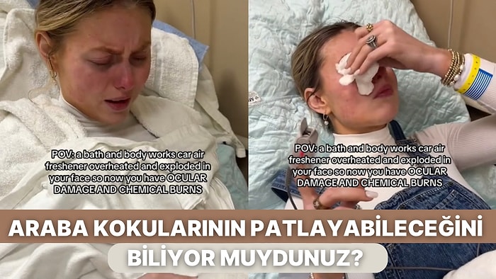 Araba Kokusu Fazla Isınınca Yüzüne Doğru Patlayan Talihsiz Kadında Kimyasal Yanıklar Oluştu