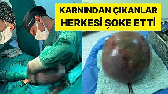 Bel Ağrısı Şikayetiyle Hastaneye Gitti: Karnından 10 kilo Ağırlığında, Tümör Çıkartıldı