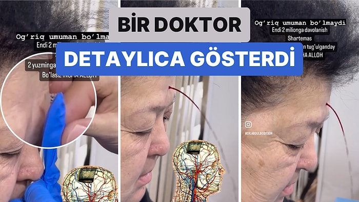 Bir Doktor Herkesin Kafasını Karıştıran Alın Delerek Yapılan Migren Tedavisini Detaylı Bir Şekilde Gösterdi