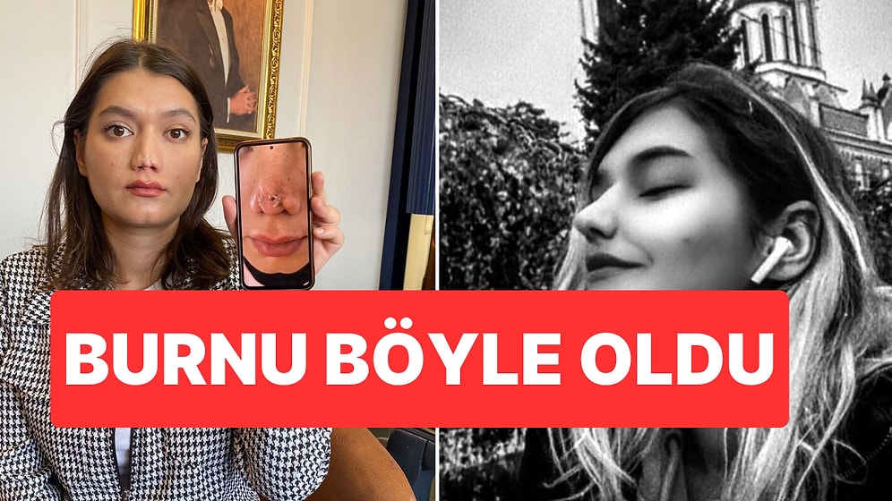 Burun Estetiği Kabusu Oldu: 1 Milyon Liralık Tazminat Davası