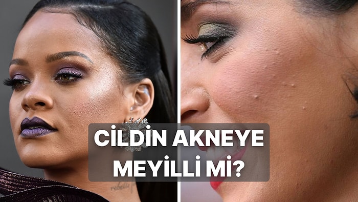 Cildin Akneye Ne Kadar Meyilli?