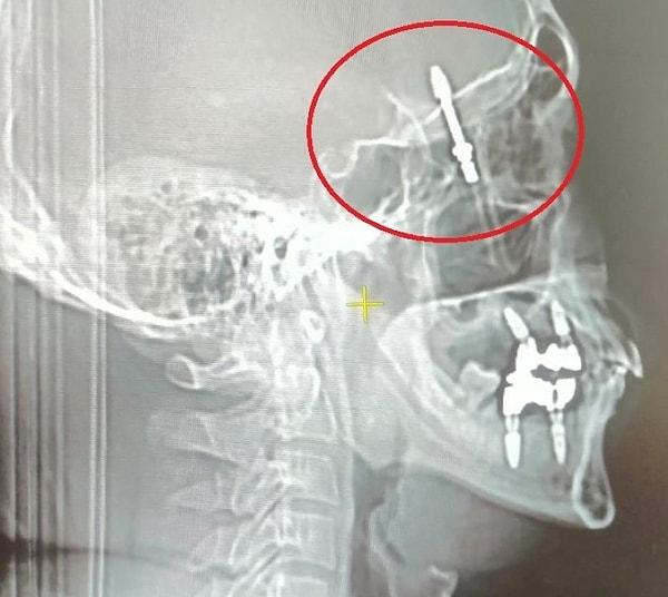 İddiaya göre, implantı çeneye yerleştirmek isteyen doktorun yanlış müdahalesi sonrası vida, Yılmaz’ın çene kemiğini delip kafatasına saplandı.