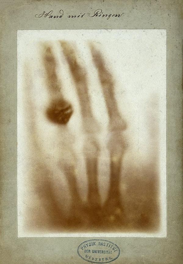 4. Bertha Röntgen'in eli, bir insanın çekilen ilk X-ışını görüntüsüdür. (22 Aralık 1895)