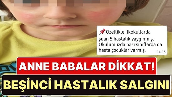 Anne Babalar Dikkat! Baharın Çocuklara Kötü Sürprizi: Beşinci Hastalık!