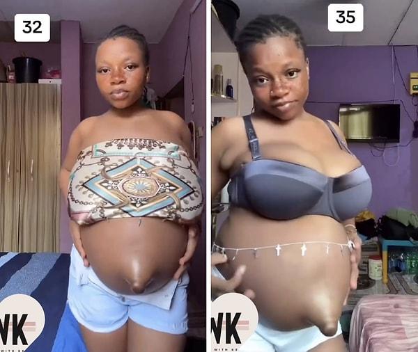 Göbek fıtığı olan bir kadın, hamilelik sürecinde vücudunda meydana gelen değişimi paylaştı.