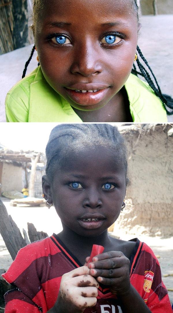 1. Waardenburg Sendromu sonucunda gözleri parlak mavi olan bir kız çocuğu.
