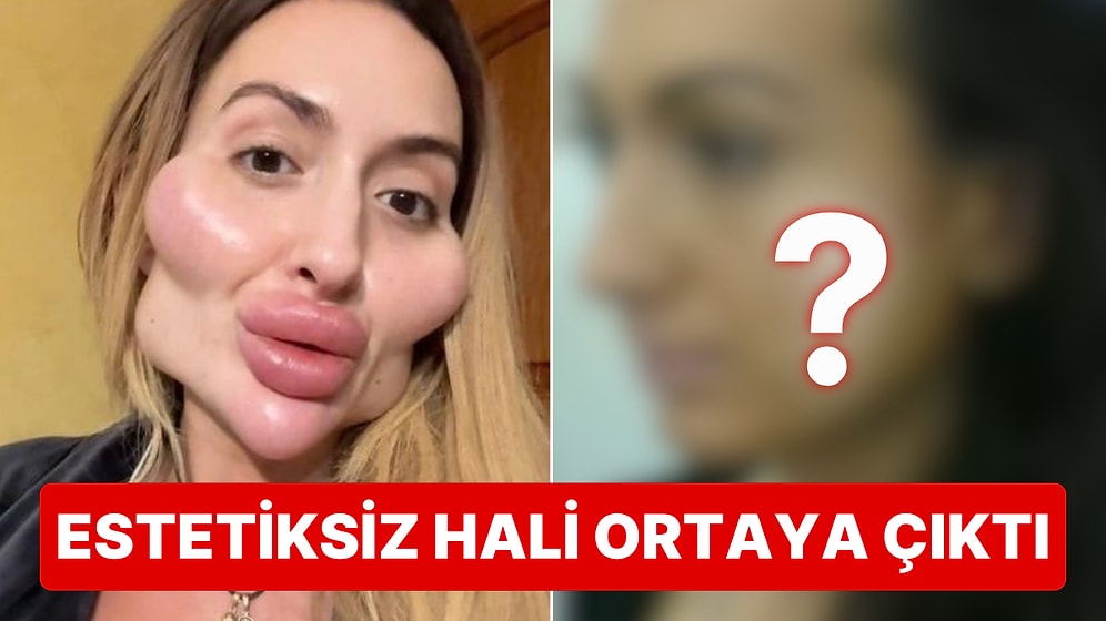 Dünyanın En Büyük Elmacık Kemiklerine Sahip Anastasia Pokreshchuk’un Estetiksiz Hali Görenleri Şoke Etti!