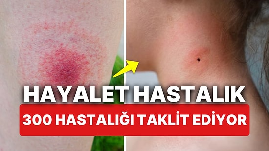 Hayalet Hastalık Olarak Biliniyor! Uzmanlar Uyarıyor 'Lyme' 300 Ayrı Hastalığı Taklit Ediyor!