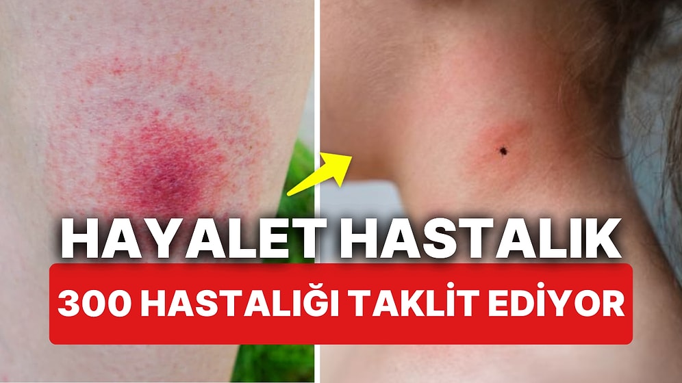 Hayalet Hastalık Olarak Biliniyor! Uzmanlar Uyarıyor 'Lyme' 300 Ayrı Hastalığı Taklit Ediyor!