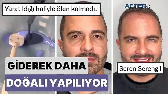 Giderek Daha da Doğalı Yapılıyor: Bir Adam Son Dönemde Popüler Olan Göz Rengi Değiştirme Operasyonunu Paylaştı