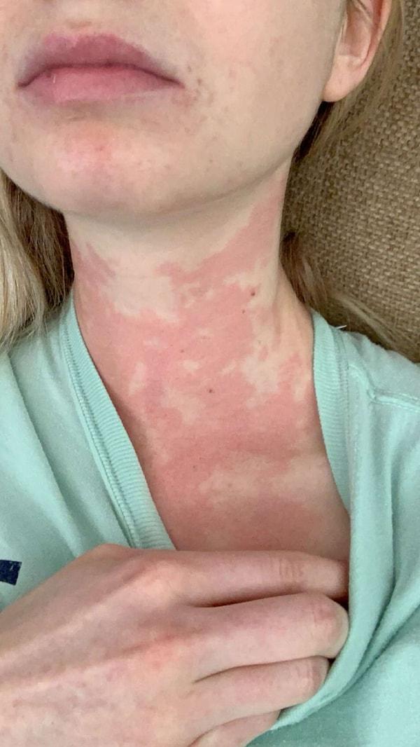 2017 yılında Caroline Cray, bağışıklık sisteminin alerjen maddeye aşırı şiddetli tepki vermesi sonucu anafilaktik şoka girdi.