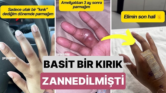 Bir Kadın Basit Bir Kırık Sanılan Şişliğin Tümör Olduğunun Geç Fark Edilmesiyle Yaşadığı Süreci Paylaştı