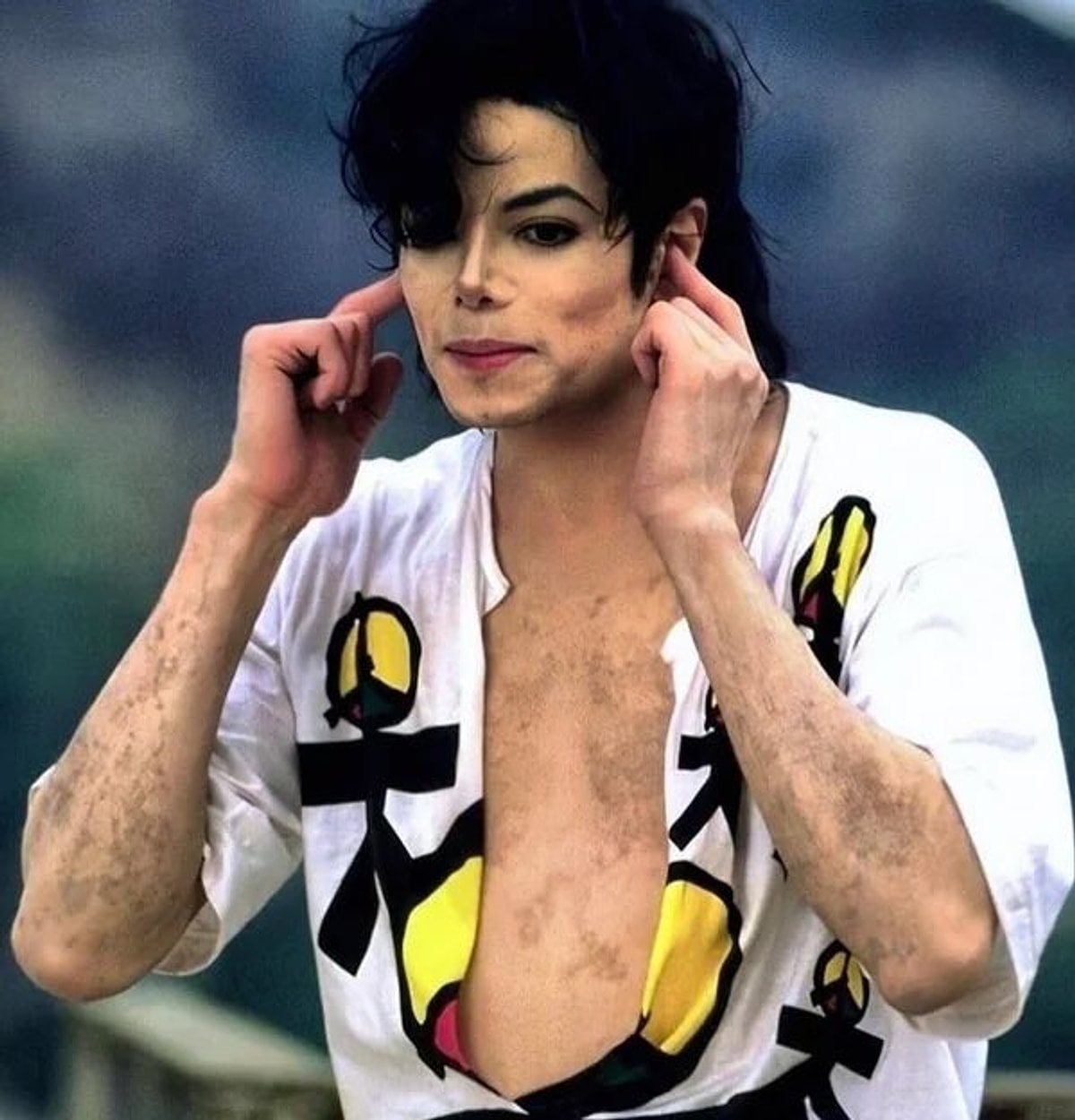 Beyazlamaya Çalıştığı Söylenen Michael Jackson'ın Vitiligo Hastalığına