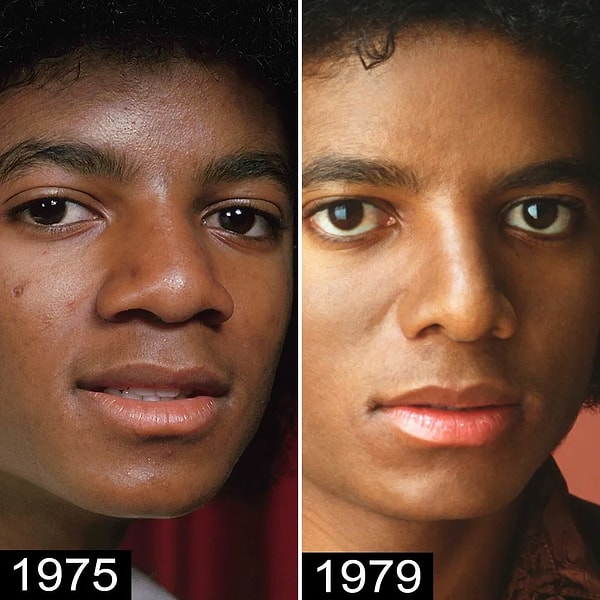 Michael Jackson'ın ilk estetik operasyonunu ise 1979 yılında, dans ettikten sonra burnunun kırılmasının ardından yaptırdığı belirtiliyor.