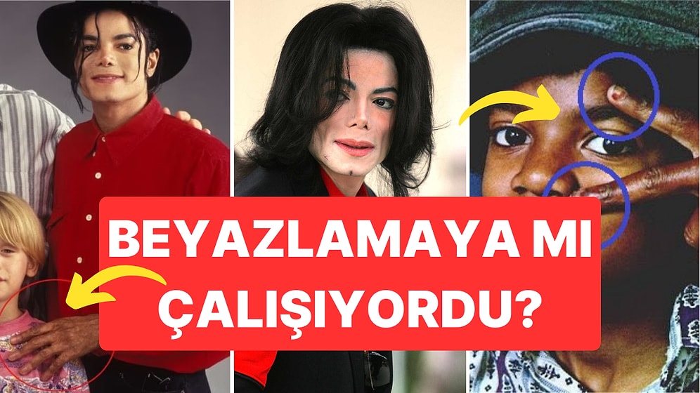 Beyazlamaya Çalıştığı Söylenen Michael Jackson'ın Vitiligo Hastalığına Dair Bilinmeyen Detaylar