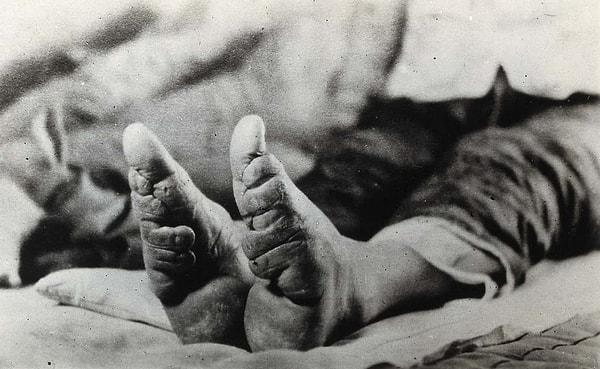 5. Lotus ayakları olarak da bilinen ayak bağlama, 8. yüzyıldan itibaren Çinli kadınlar arasında popüler olan bir uygulamaydı