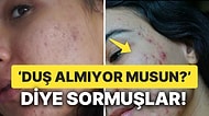 Sivilceleri Olduğu İçin Çevresi Tarafından Aşağılanan Kadının Tüm Herkese İlham Veren Hikayesi