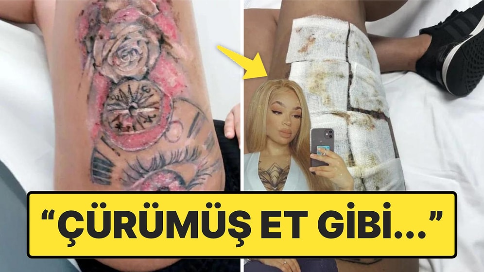 Dövme Yaptırdıktan Sonra Enfeksiyon Kaparak Hayatı Adeta Cehenneme Dönen Kadın