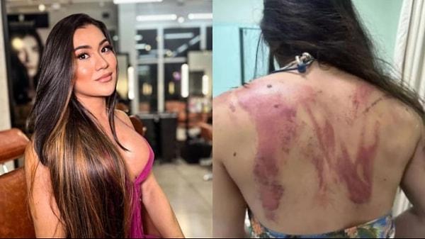 Edinilen bilgiye göre, 33 yaşındaki diş hekimi Bruna Tsuchiya, babasının saldırısına uğradığını açıklayarak yaşadığı şiddetin boyutunu gösteren fotoğraflarını yayınladı.