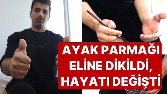 350 Tonluk Pres Makinesinin Parmaklarını Kopardığı Eline Ayak Parmakları Dikildi