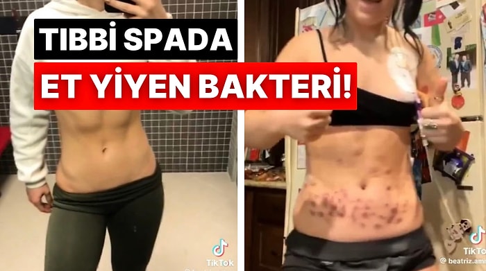 Vitamin İnfüzyonu İçin Tıbbi Spaya Giden Kadının Et Yiyen Bir Bakteri Sonucu Hayatı Karardı