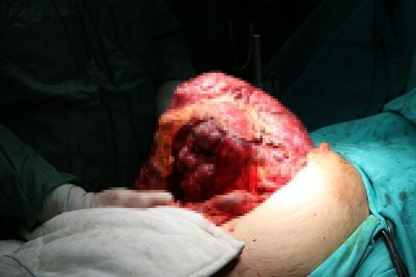 Karnının en alt bölümünden kalbin altına kadar uzanan tümör, 4 saatlik operasyonla başarılı bir şekilde çıkartıldı.