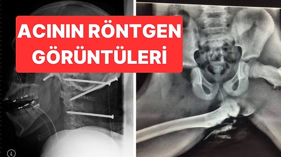 Yeni Fobiler Yükleniyor! Akılamaz Kazaların Ardında Bıraktığı Korkunç Röntgen Görüntüleri