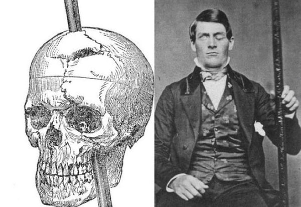 8. Phineas Gage, kafatasını delip geçen demir çubuğa rağmen hayatta kaldı: Beyin hasarını da atlatmayı başardı!