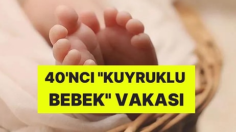 Böylesi Ne Görüldü Ne de Duyuldu! Tıp Dünyası Şokta: Bebek Kuyrukla Dünyaya Geldi