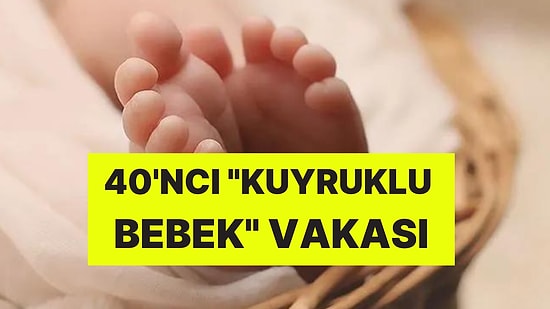 Böylesi Ne Görüldü Ne de Duyuldu! Tıp Dünyası Şokta: Bebek Kuyrukla Dünyaya Geldi