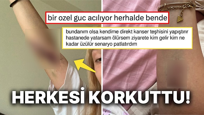 Yeni Fobimiz Hayırlı Olsun: Kollarında Durduk Yere Çıkan Morlukları Paylaşan Kullanıcı Tartışma Yarattı