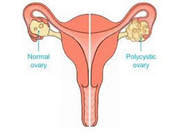 Bu hormonal dengesizlik, genellikle aşağıdaki belirtilere ve duruma yol açabilir: