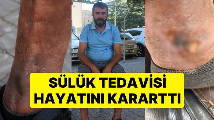 Sülük Tedavisi Hayatını Kararttı: Bacakları Yara Oldu, Yürümekte Zorlanıyor