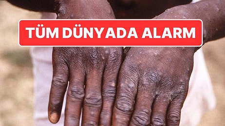 DSÖ’den Maymun Çiçeği Açıklaması: Tüm Dünyada Acil Durum İlan Edildi